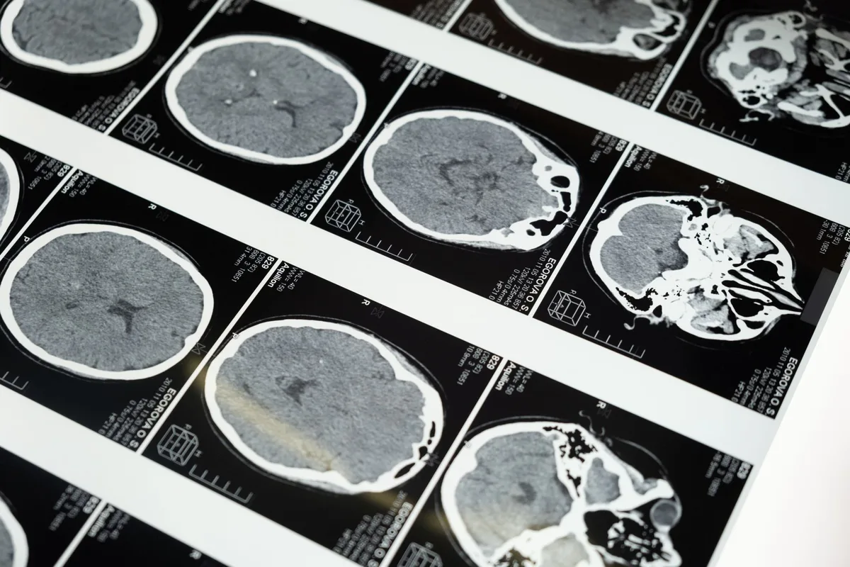 An MRI film on a lightbox in a dark room.