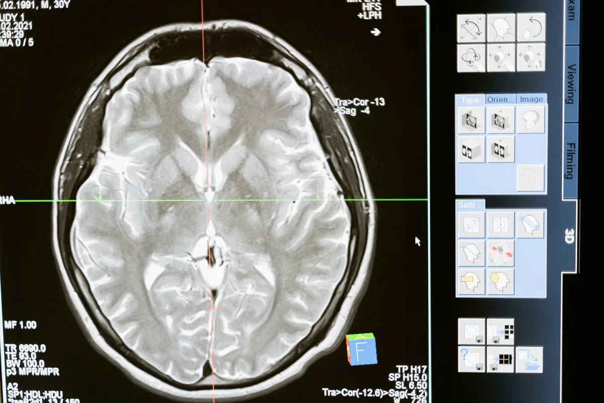 Brain imaging displayed on a monitor in a darkened room.