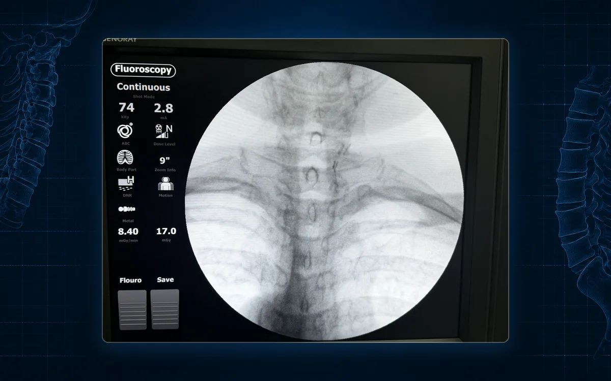 Fluoroscopy of the cervical spine, with surgical clips from a prior thyroid operation visible at the front of the neck.